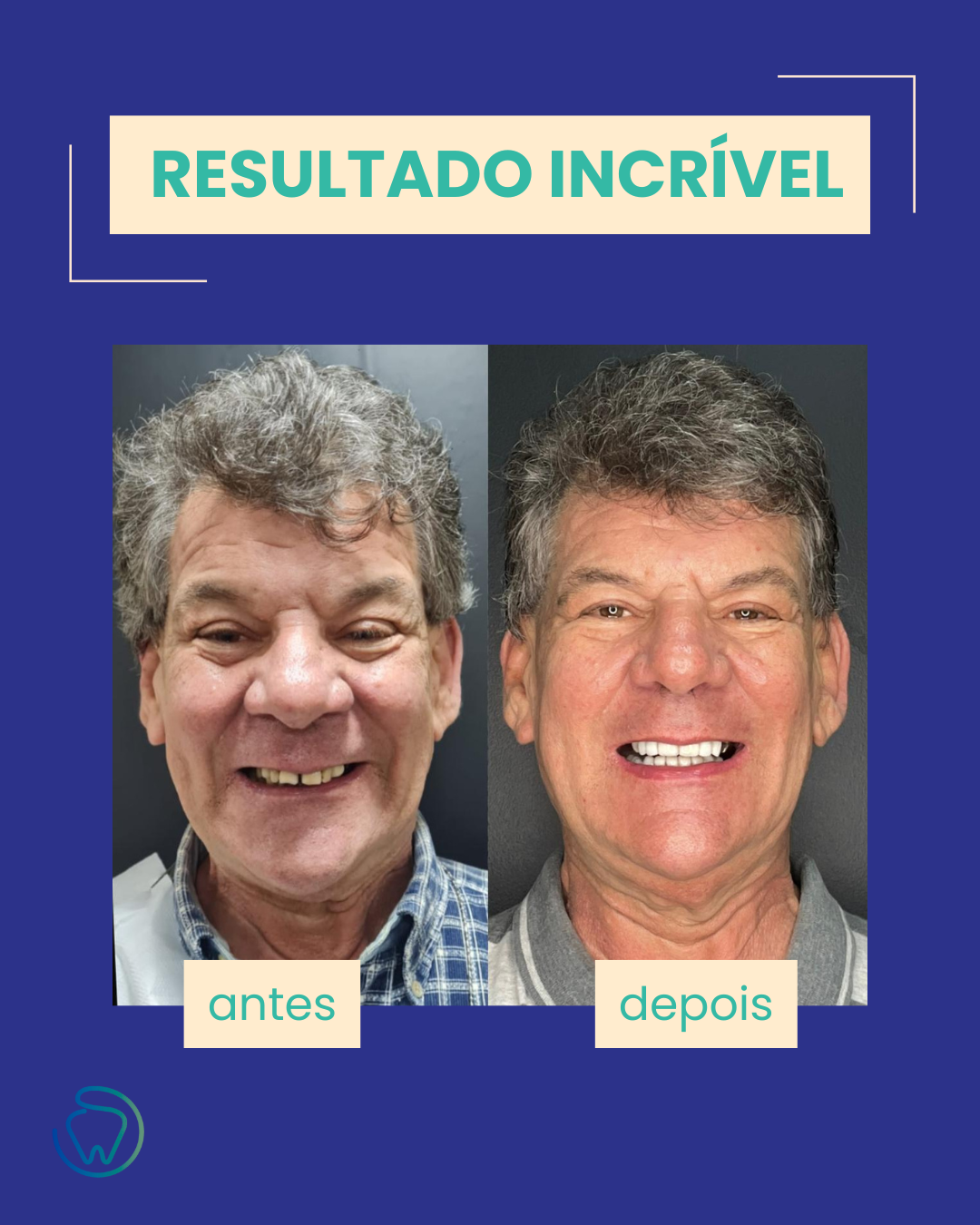 Antes e depois de tratamento de implante dentário — resultado