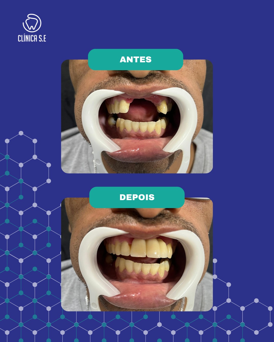 Antes e depois de reabilitação dentária completa